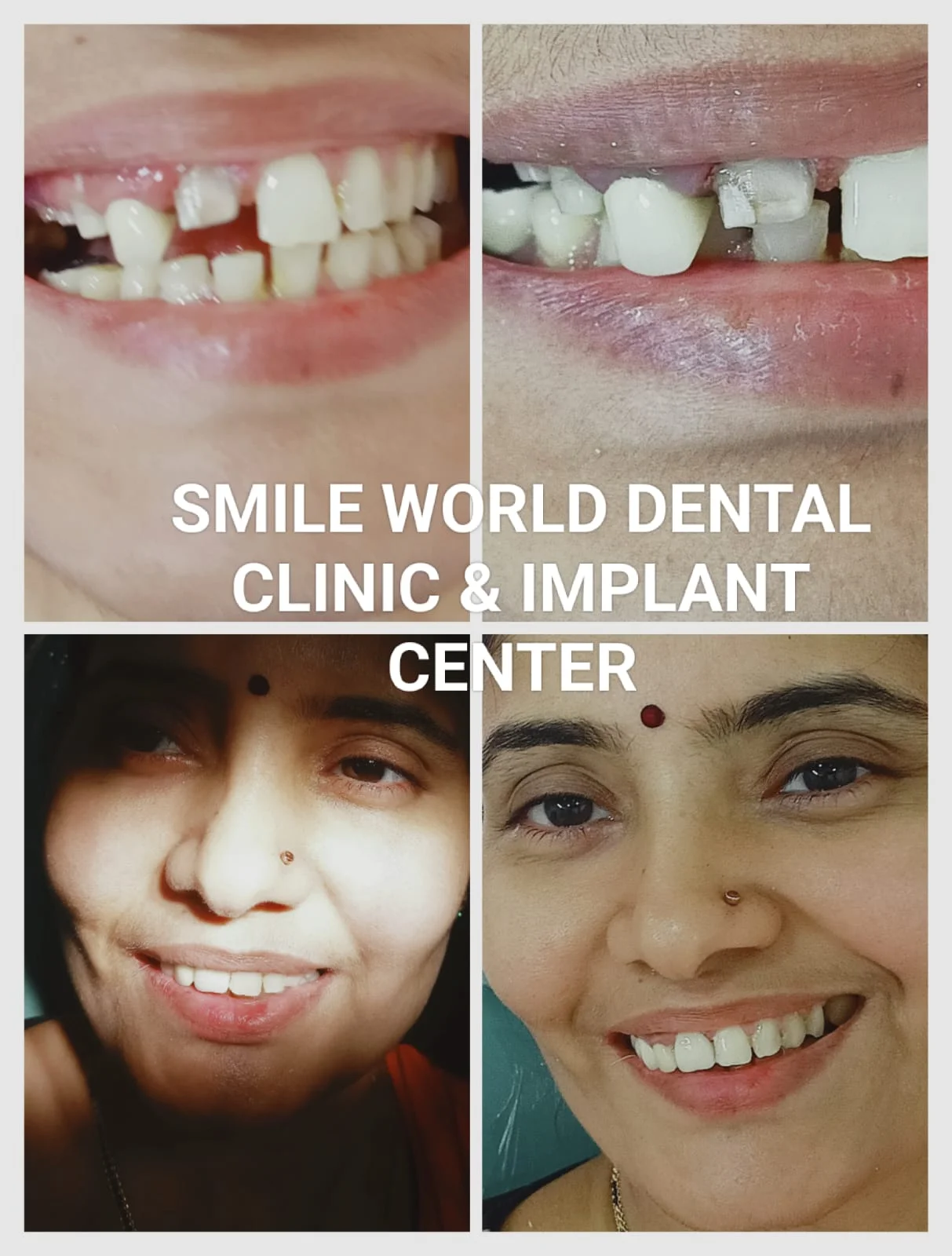 Anterior Smile Correction #7